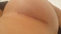 Good scar after breast augmentation no infection