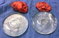 Saline breast implant rupture and new breast implants