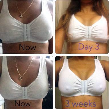 Breast Augmentation Recovery Time 103