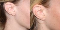 18-24 year old woman treated with Ear Lobe Surgery