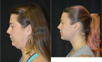 25-34 year old woman treated with Neck Lift