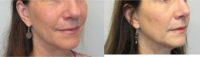 57 year old woman treated with Rhinoplasty