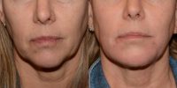 55-64 year old woman treated with Chin Fillers