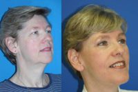 55-64 year old woman treated with Facelift, Endoscopic Brow Lift, Blepharoplasty