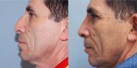 55-64 year old male treated with Rhinoplasty