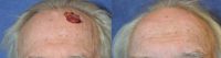 75 and up year old man treated with Scar Removal