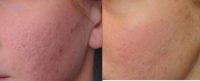 Cheek dermabrasion for acne scars