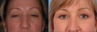 44 year old woman treated with Eyelid Surgery