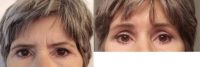Brow Lift with upper eyelid surgery