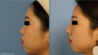 Woman treated with Nose Surgery