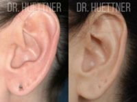 44 year old woman treated with Earlobe Surgery