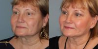 60 year old woman treated with SMAS Facelift