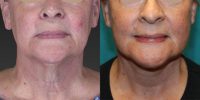 55-64 year old woman treated with MACS Facelift