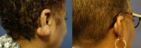 55-64 year old woman - excision of right earlobe keloid