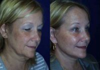 55-64 year old woman treated with Facelift