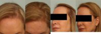 55-64 year old woman treated with Hair Transplant