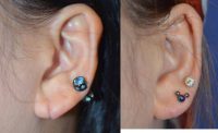 35-44 year old woman treated with Ear Lobe Surgery