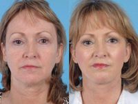 58 year old woman treated with Facelift