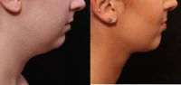18-24 year old woman treated with Neck Lift