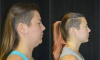 31 year old woman who underwent submental (neck) liposuction