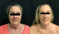 65-74 year old woman treated with Facial Fat Transfer