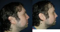 25-34 year old man treated with Septoplasty
