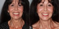 64 year old woman treated with SMAS Facelift