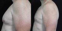 45-54 year old man treated with CoolSculpting