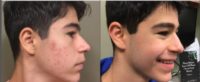 17 or under year old man treated with Accutane