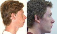 19 year old male treated with Chin Surgery