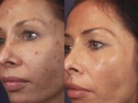 25-34 year old woman treated with Chemical Peel