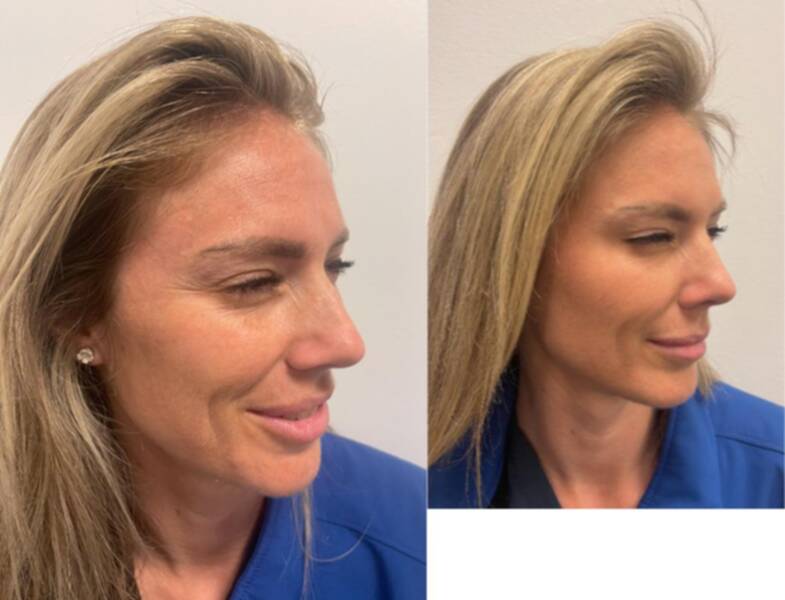 25-34 year old woman treated with botox and fillers in the nasolabial folds, marionettes lines, and cheek bones.