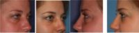 34 year old woman with thyroid eye disease treated for puffy lower lids