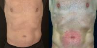 35-44 year old man treated with Emsculpt NEO