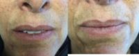 45-54 year old woman treated with Juvederm Ultra XC to nasolabial folds