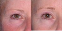 45-54 year old woman treated with Ultherapy Brow Lift