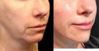 45-54 year old woman treated with Chin Filler