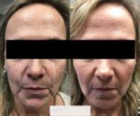 45-54 year old woman treated with Radiesse