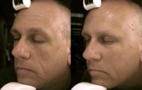 48 year old man treated with Sculptra for full-facial volume