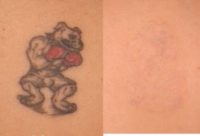 45-54 year old man treated with Tattoo Removal
