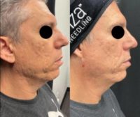 45-54 year old man treated with Potenza
