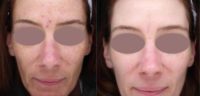 45-54 year old woman treated with Halo Laser