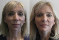 56 year old female TMJ, Orthognathic, and Facelift Surgery