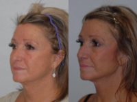 55-64 year old woman treated with Revision Facelift