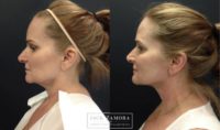 55-64 year old woman treated with Non-Surgical Neck Lift