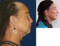 55-64 year old woman treated with Facial Feminization Surgery