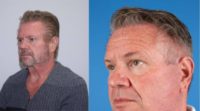 55-64 year old man treated with Facelift, Neck Lift