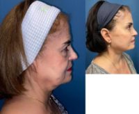55-64 year old woman treated with Deep Plane Facelift, Facelift, Facial Fat Transfer, Brow Lift