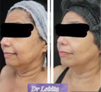55-64 year old woman treated with Skin Rejuvenation