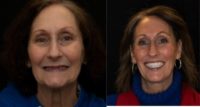 55-64 year old woman treated with All-on-6 Dental Implants on upper & lower.